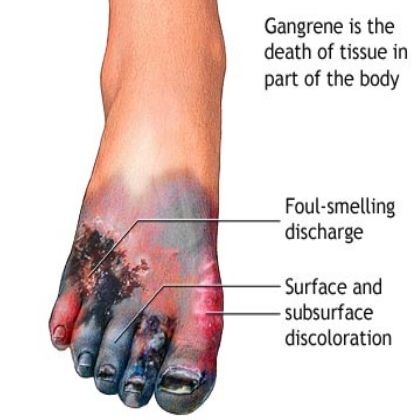 condition of someone who're having diabetes can be showed.